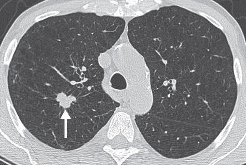 Solitary And Multiple Pulmonary Nodules Radiology Key 