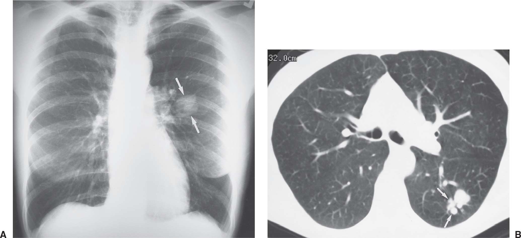 What Does Lobulated Nodule Mean Slidesharetrick