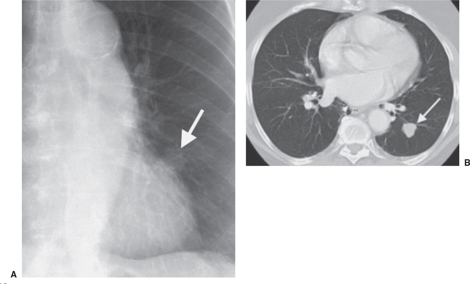 Solitary and Multiple Pulmonary Nodules Radiology Key