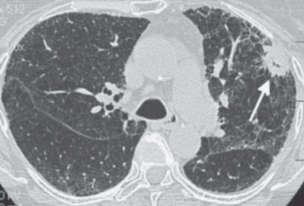 Solitary And Multiple Pulmonary Nodules Radiology Key 