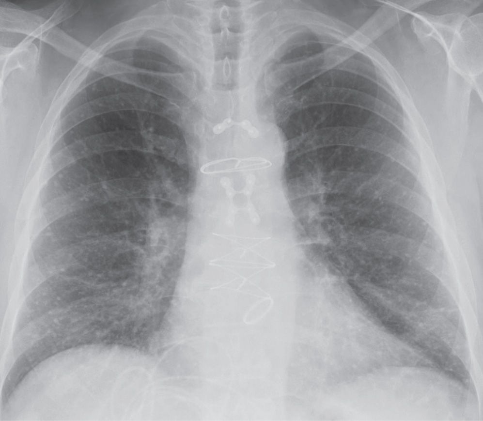 solitary-and-multiple-pulmonary-nodules-radiology-key