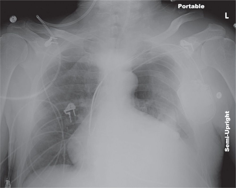 Chest Trauma | Radiology Key