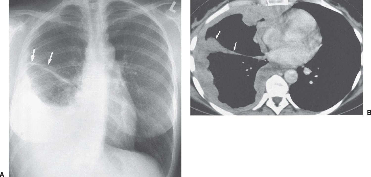 Pleura, Chest Wall, and Diaphragm  Radiology Key