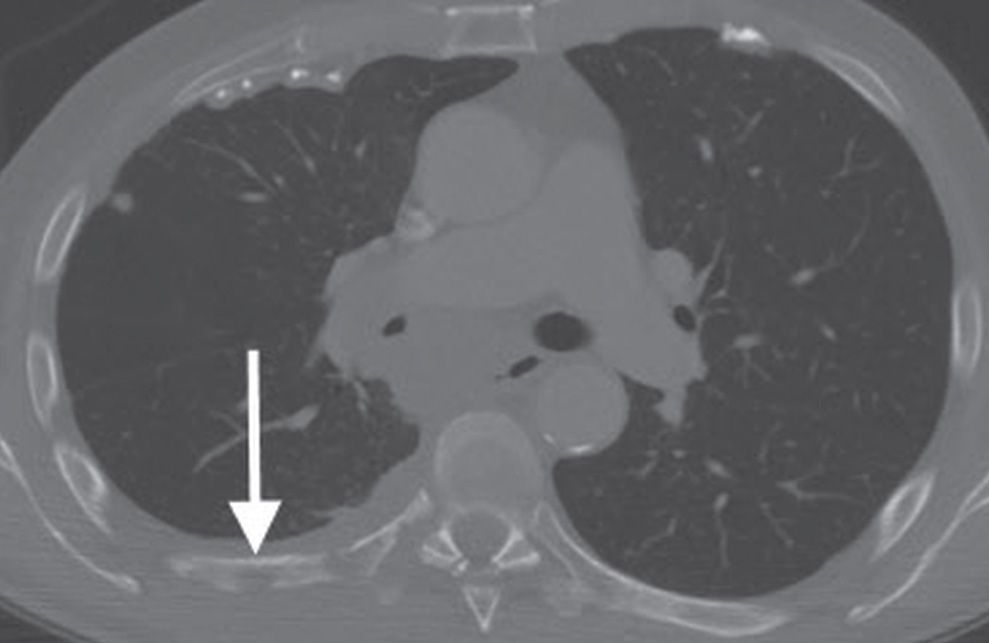 Pleura, Chest Wall, and Diaphragm Radiology Key