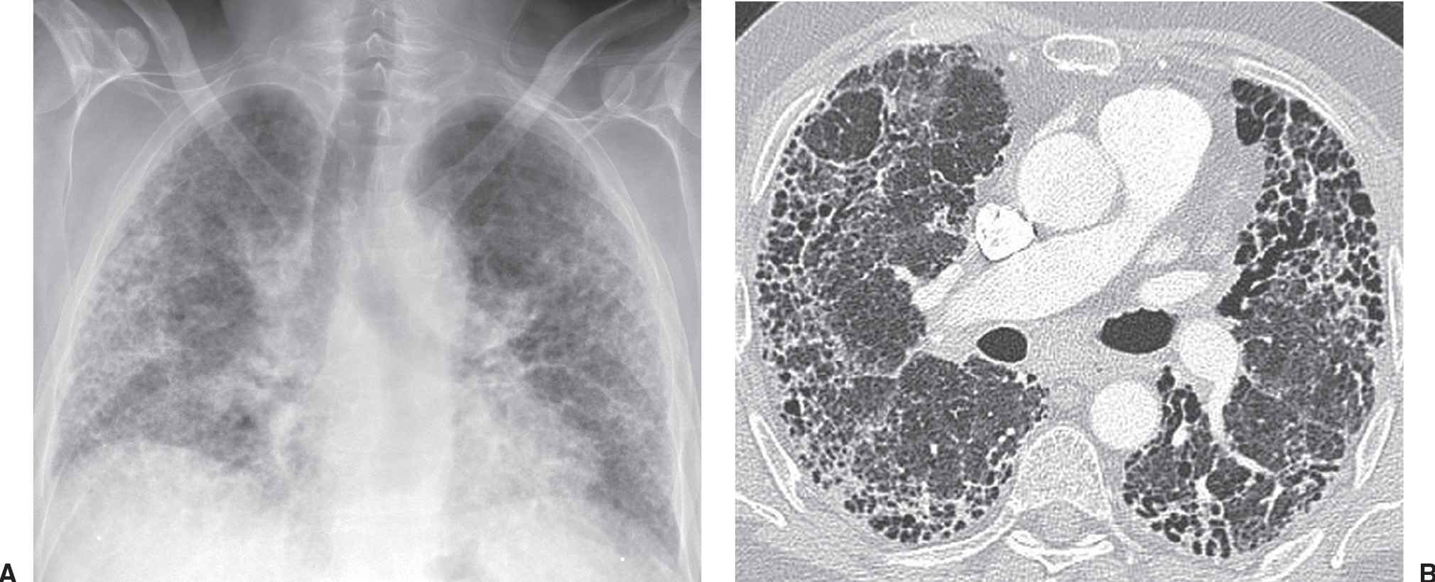 Peripheral Lung Disease | Radiology Key