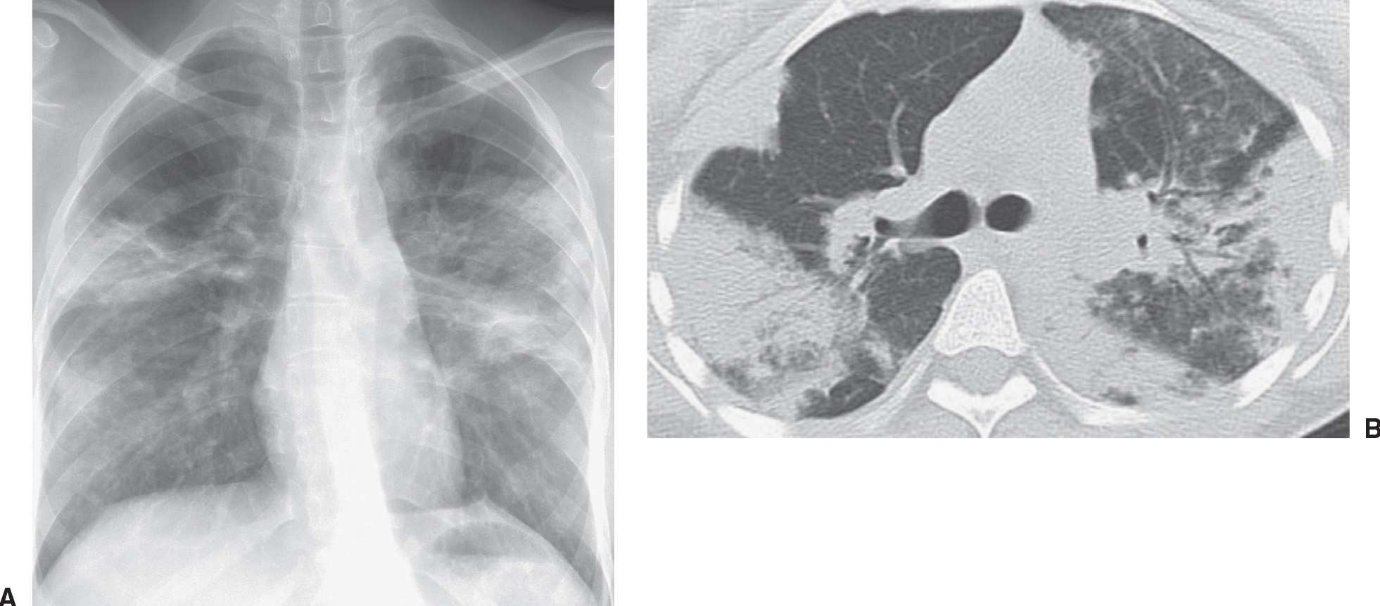 Peripheral Lung Disease | Radiology Key