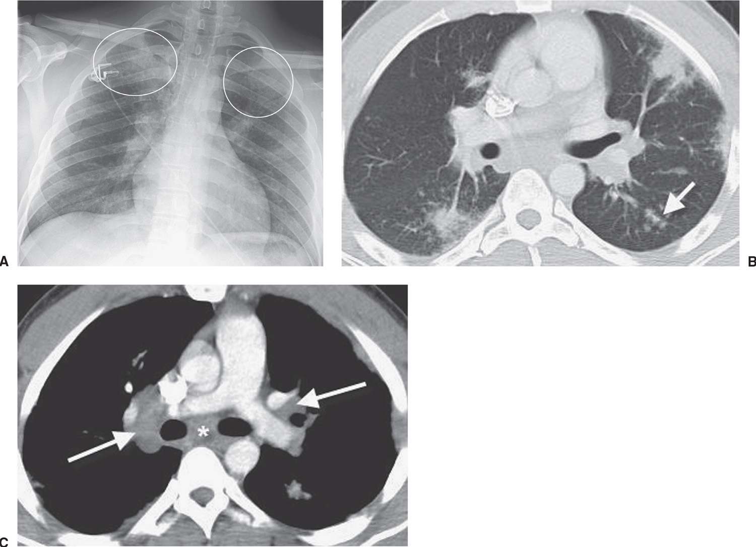 Peripheral Lung Disease | Radiology Key