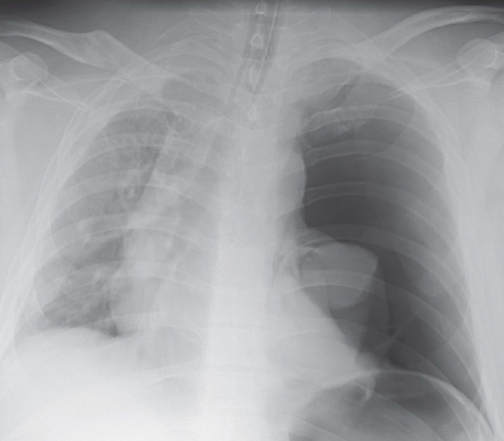 left hemothorax x ray