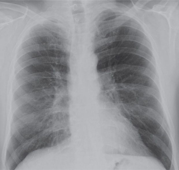 atelectasis chest x ray