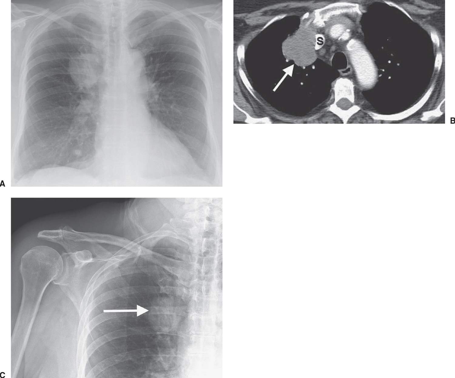 neoplasms-of-the-lung-radiology-key