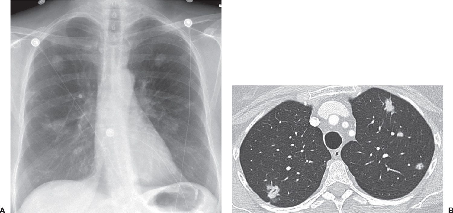 neoplasms-of-the-lung-radiology-key