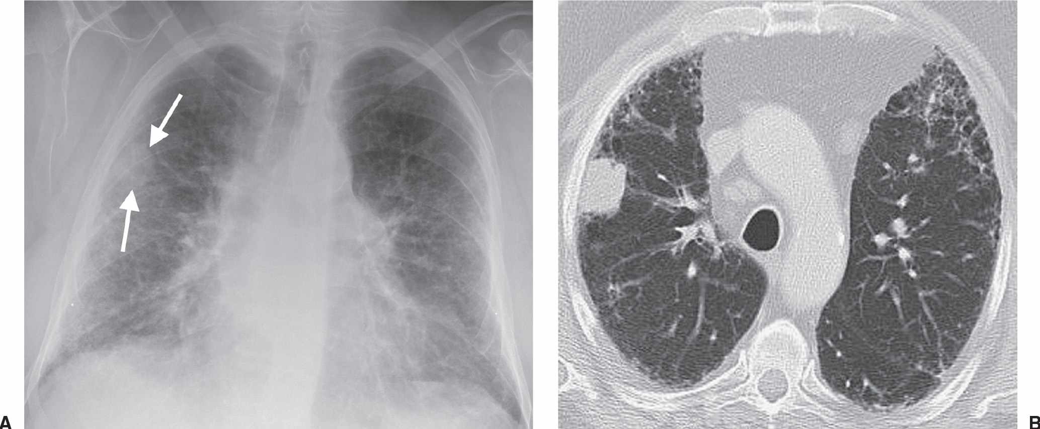 Lung Neoplasms 