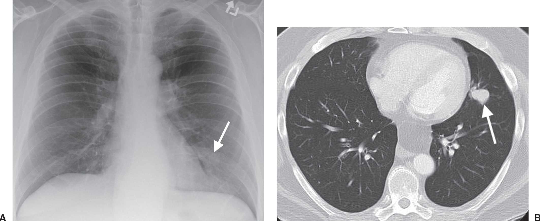 neoplasms-of-the-lung-radiology-key