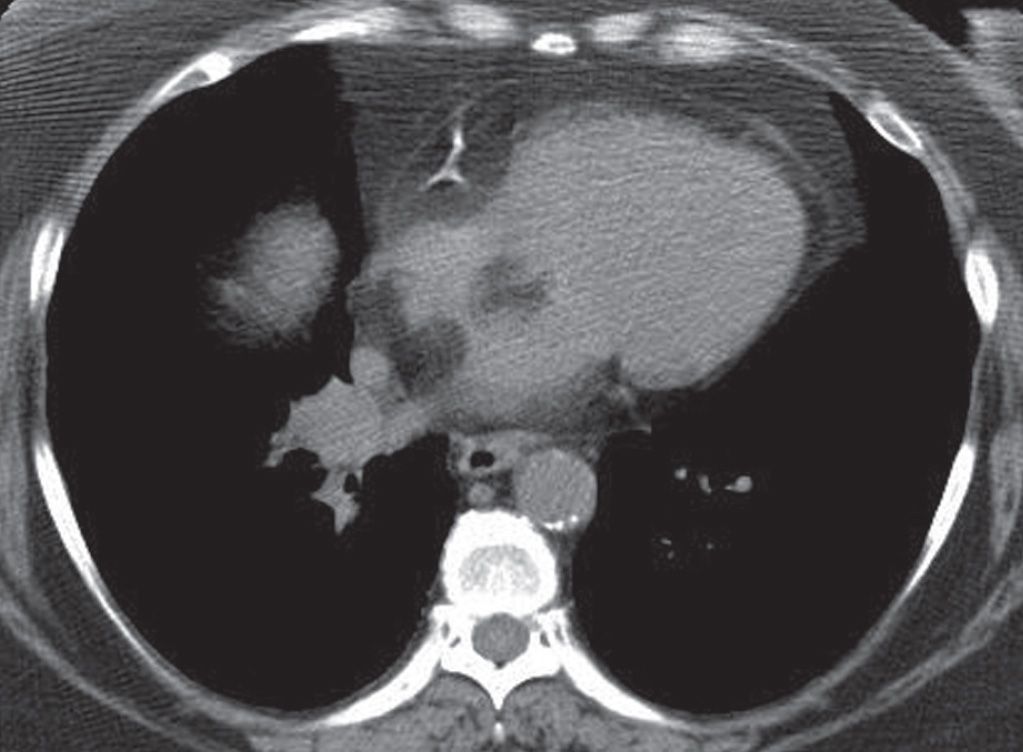 Interstitial Lung Disease | Radiology Key