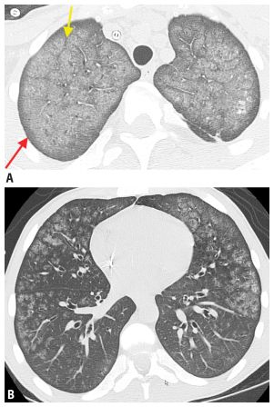 Pulmonary Vascular Diseases | Radiology Key