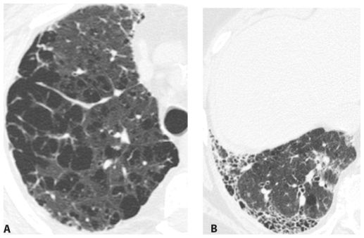 smoking-related-lung-disease-radiology-key