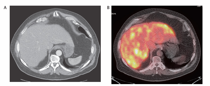 How is a PET scan used in liver cancer?