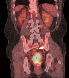 pet scan colon cancer