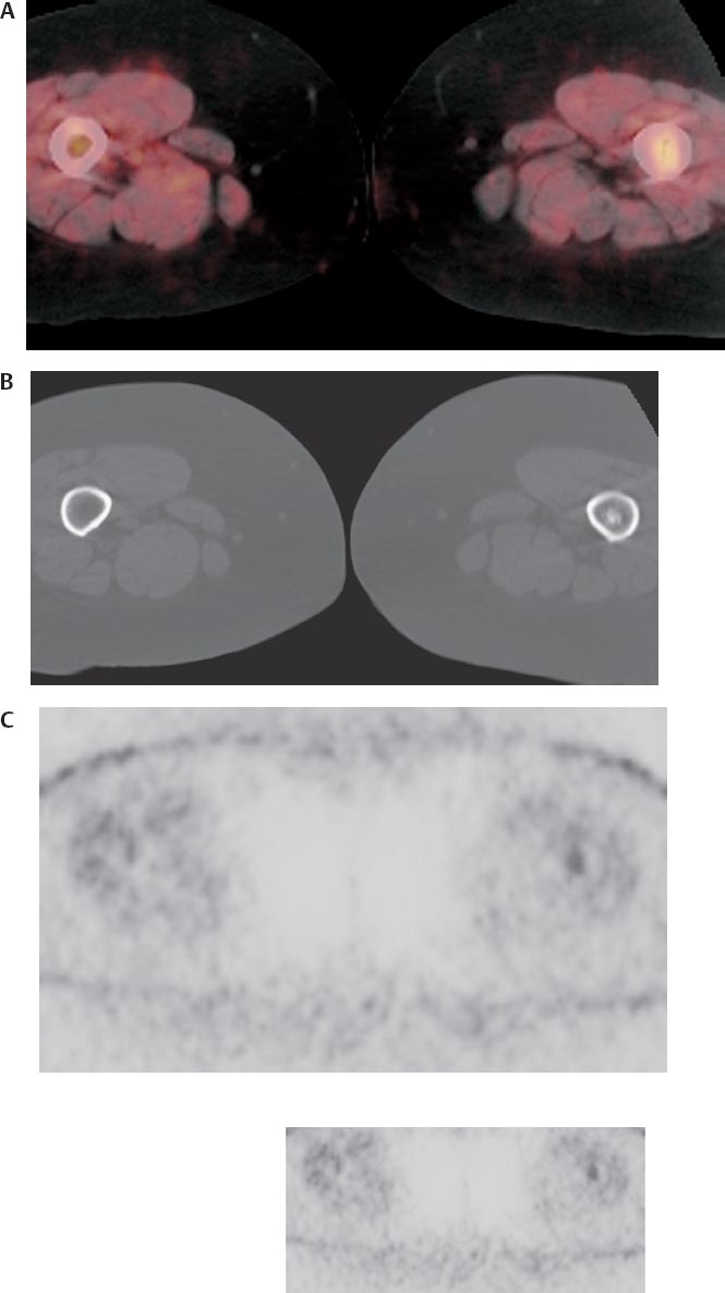 Musculoskeletal Tumors Radiology Key