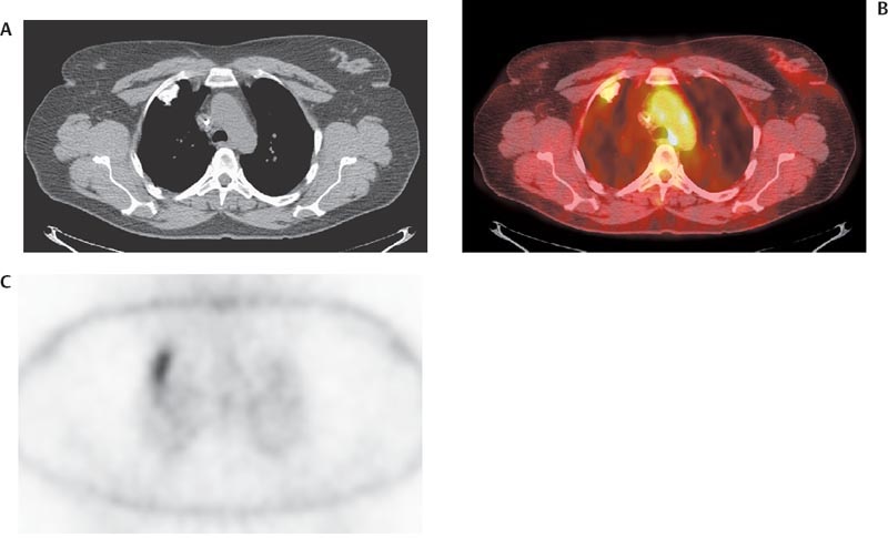 Musculoskeletal Tumors Radiology Key