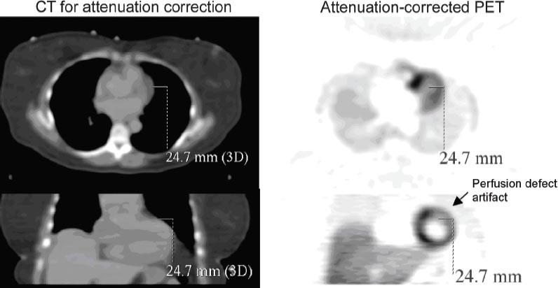 Cardiac PET and PET/CT | Radiology Key