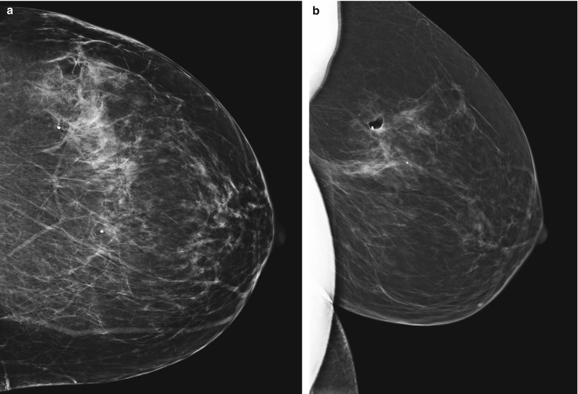 Mammography And Ultrasound Review | Radiology Key