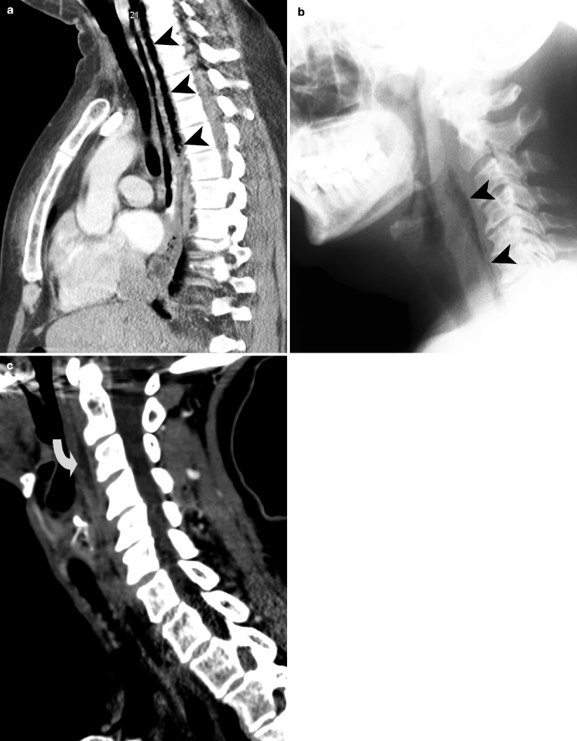 peritonsillar abscess x ray