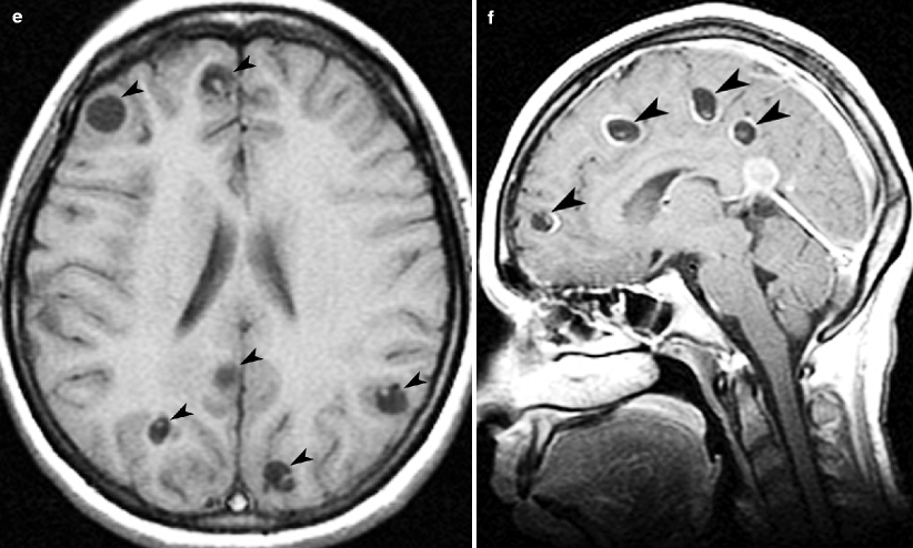 Imaging of Acute Head Emergencies | Radiology Key