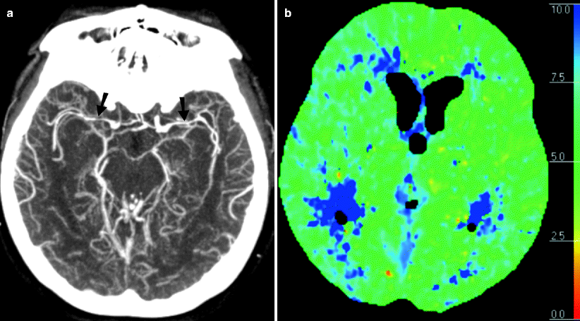 Stroke And Its Imaging Evaluation | Radiology Key