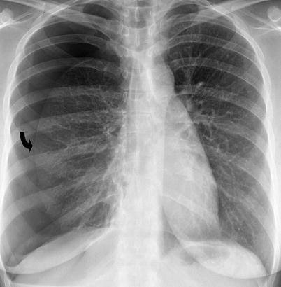 Imaging of Nontraumatic Mediastinal and Pulmonary Processes | Radiology Key