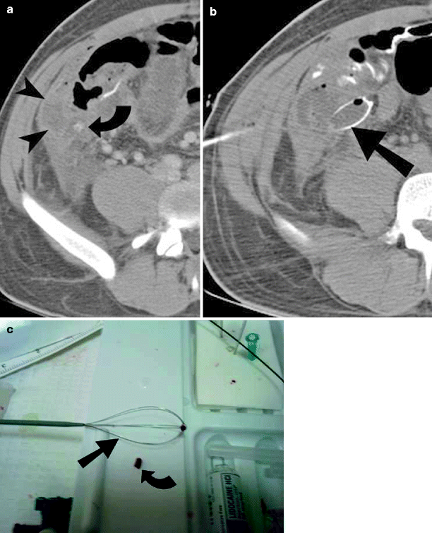 acute-appendicitis-radiology-key