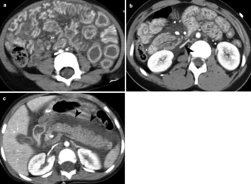 Imaging Of Blunt And Penetrating Abdominal Trauma | Radiology Key