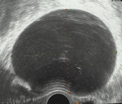 Teratomas: Clinical Setting and Ultrasound Findings | Radiology Key