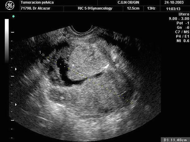 ovarian-tumors-serous-mucinous-endometrioid-clear-cell-carcinoma