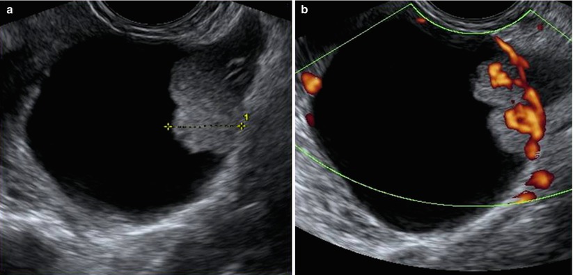 ovarian yolk sac tumor ultrasound