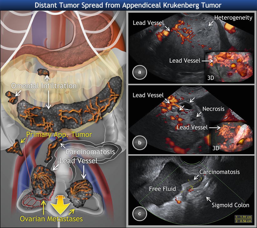 Ovarian Tumors Clinical Setting And US Radiology Key