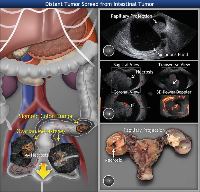 Ovarian Tumors Clinical Setting And Us Radiology Key 