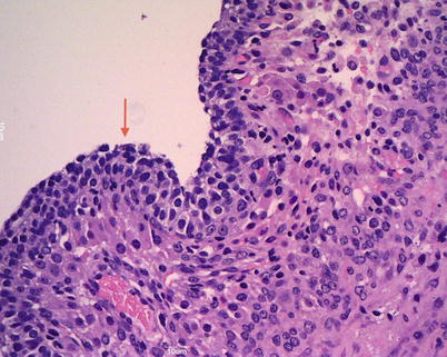 ovarian cyst histology