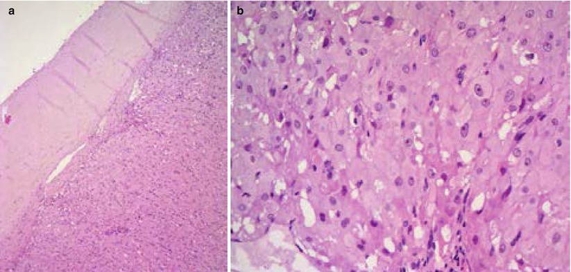 ovarian cyst histology