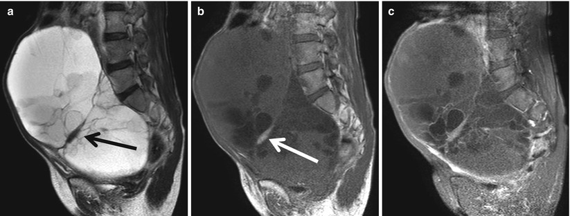 Surface Stromal Tumors Of The Ovary Computed Tomography