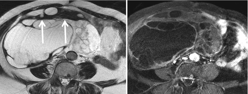 Surface Stromal Tumors of the Ovary: Computed Tomography and Magnetic ...