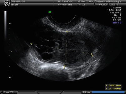 Benign Sex Cord-Stromal Tumors: Clinical and Ultrasound Features ...