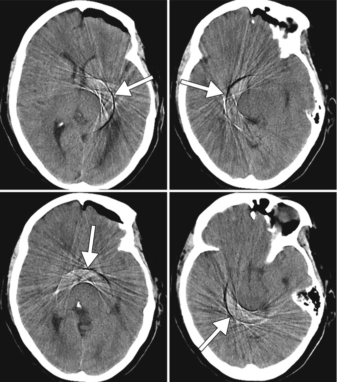 Figure 1 from CT artifacts: Causes and reduction techniques | Semantic  Scholar