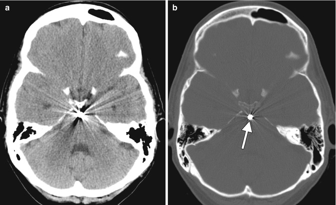 Common pitfalls of interpreting brain computed tomography (CT) sc |  Medmastery