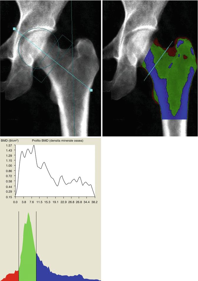 Bone Mineral Density and Quantitative Imaging | Radiology Key