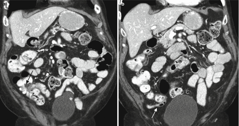 the-appendix-radiology-key