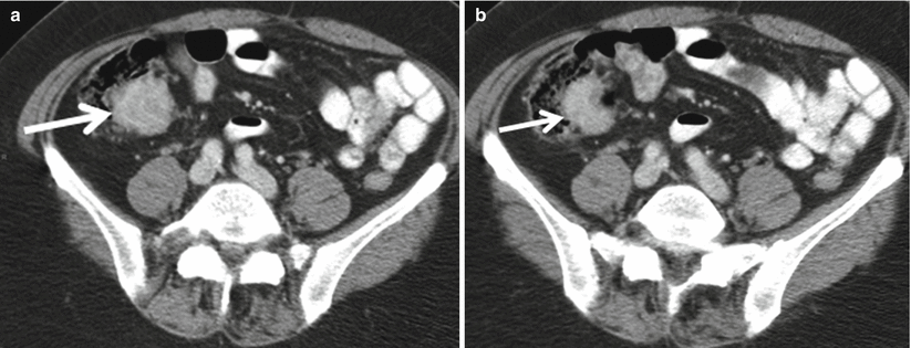 The Appendix Radiology Key 7827