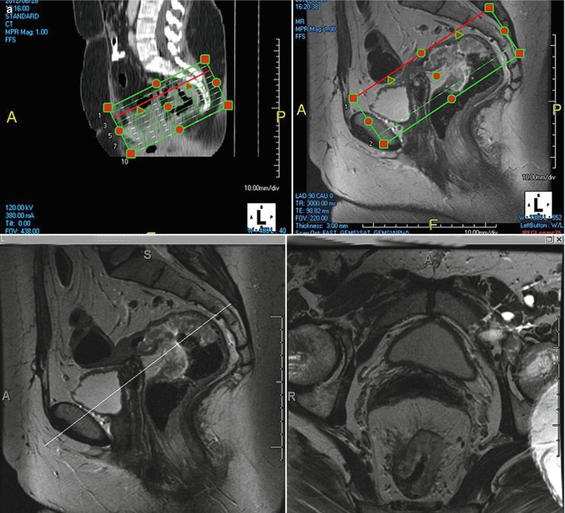 Mri Evaluation Of Rectal Carcinoma Radiology Key 