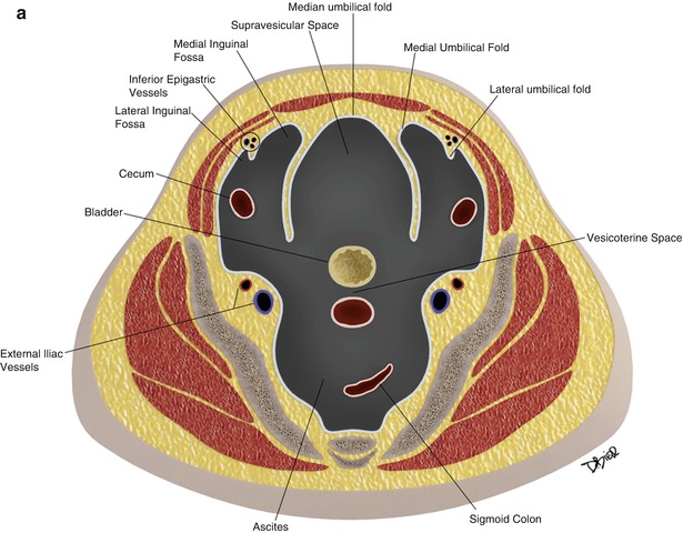 Pelvic peritoneal space  Radiology Reference Article