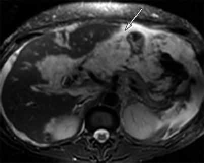 The Peritoneum | Radiology Key